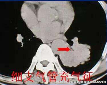 细支气管充气征